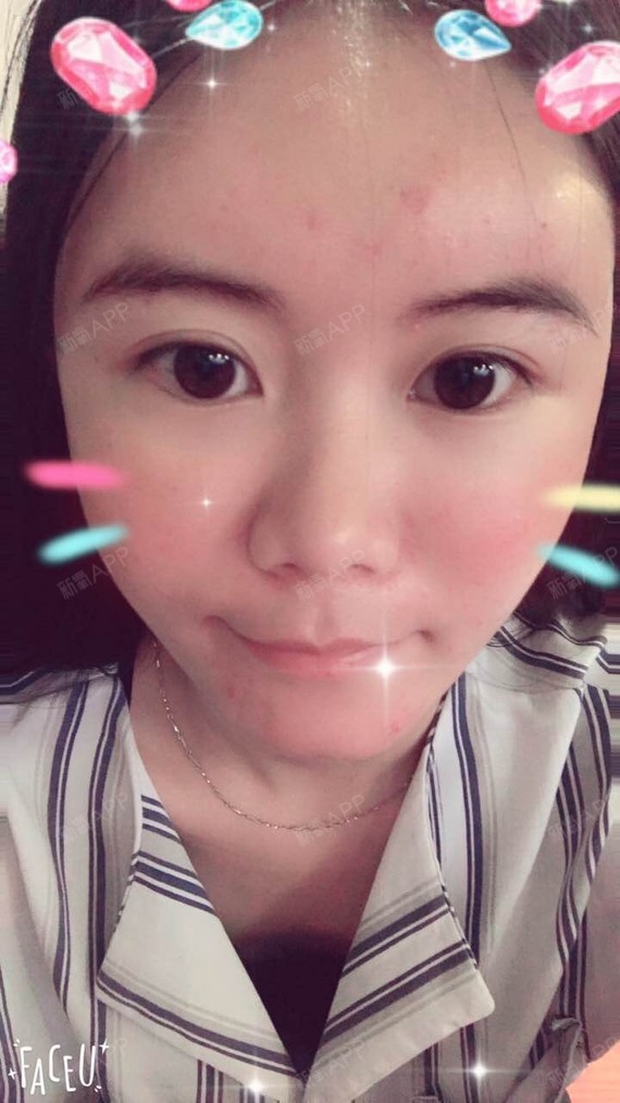 DISAPPEAR逗逗自体脂肪全脸填充第11天美丽