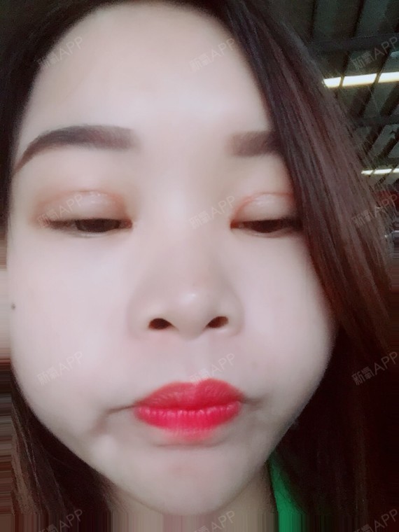 埋线双眼皮
