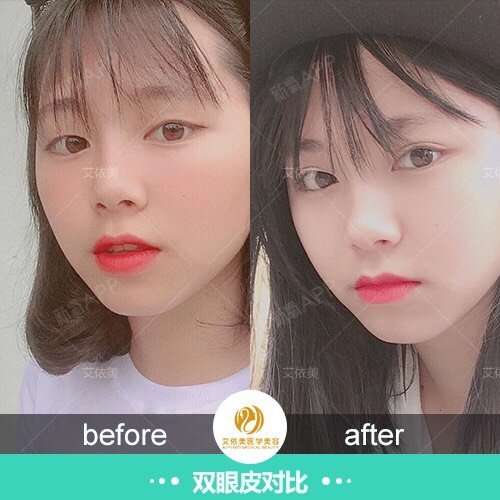 眼部整形修复的方法 1,泪小点外翻修复眼部整形_圈子-新氧美容整形