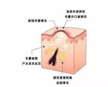什么是青春痘青春痘青春痘学名痤疮,是皮肤科
