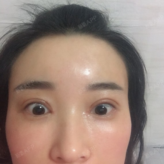 成都开内眼角好不好_效果图_灿灿525开内眼角术后第11