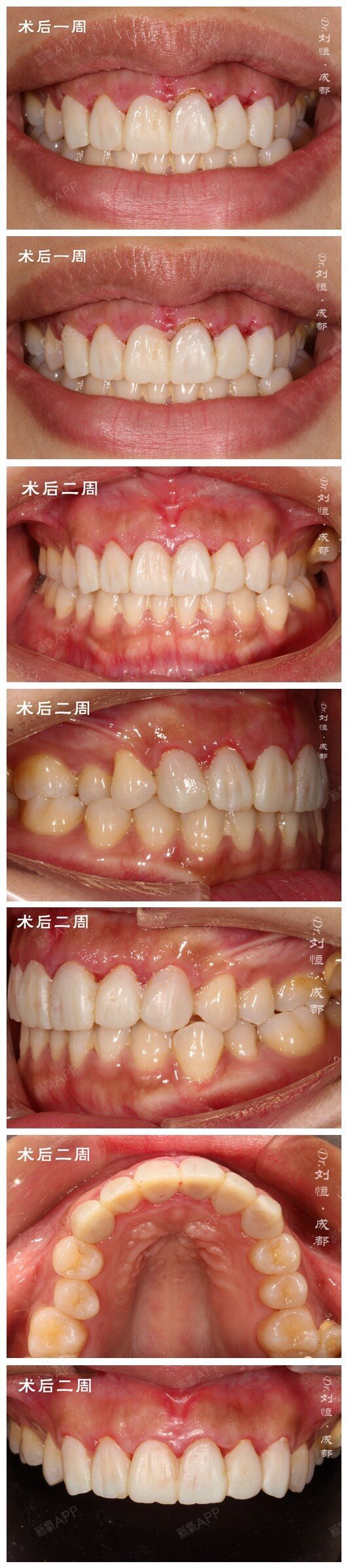 牙齿美学修复##治疗跟拍#前牙牙槽骨修整才是解决