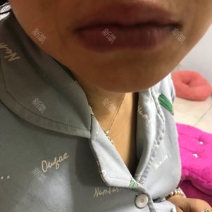 唇部综合怎么样_恢复过程_效果如何_氧气24ljf整形7.