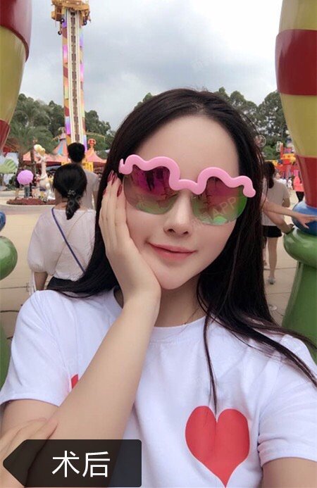 【广州美莱正版达拉斯隆鼻术】鼻头肉多,隆鼻