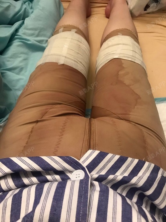 在斯美诺做了腿部吸脂,我这个胖子终于下定决心做改变了