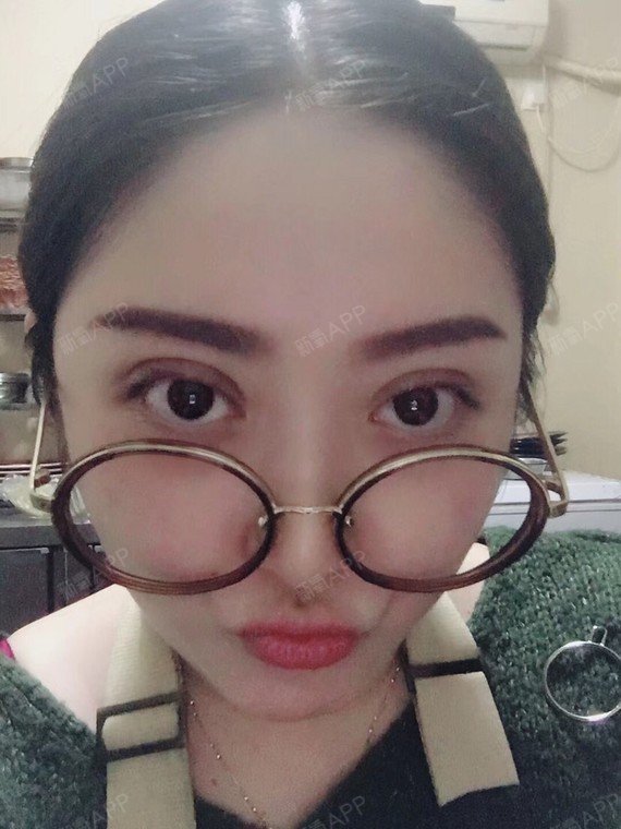 天津切开双眼皮好不好_效果图_先知的潘多拉切开双术1