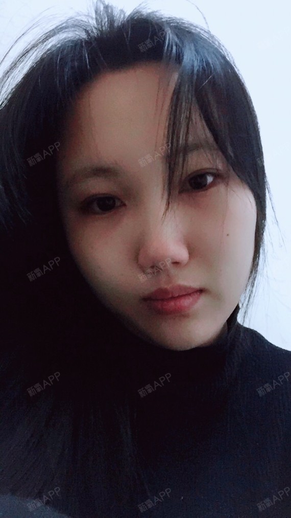 自体脂肪面部填充