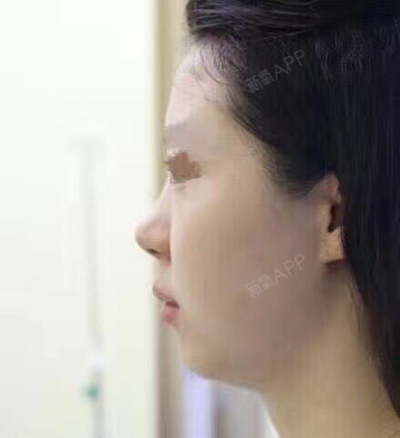 理想当中的鼻部形态:鼻孔外形为纵卵圆形、斜