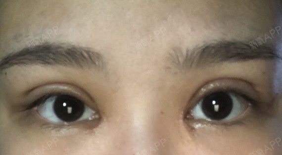 Wsqq77777开内眼角第30天美丽日记-新氧美容