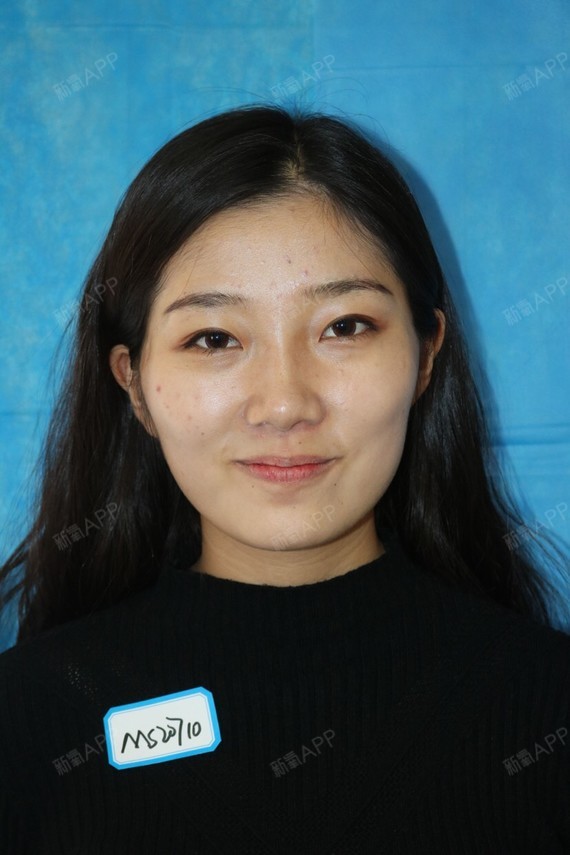 行走的蒙娜丽莎自体脂肪丰太阳穴第0天美丽日