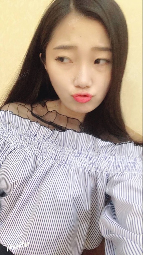 行走的蒙娜丽莎自体脂肪丰太阳穴第15天美丽