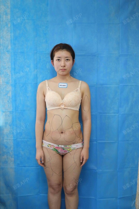 平丽雅工程瘦钢筋第0天美吸脂记-新氧美容整形手臂钢筋ppt丽日瘦身图片