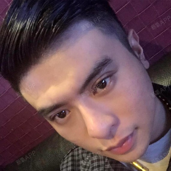 我不吃糖粘牙开内眼角第113天美丽日记-新氧美