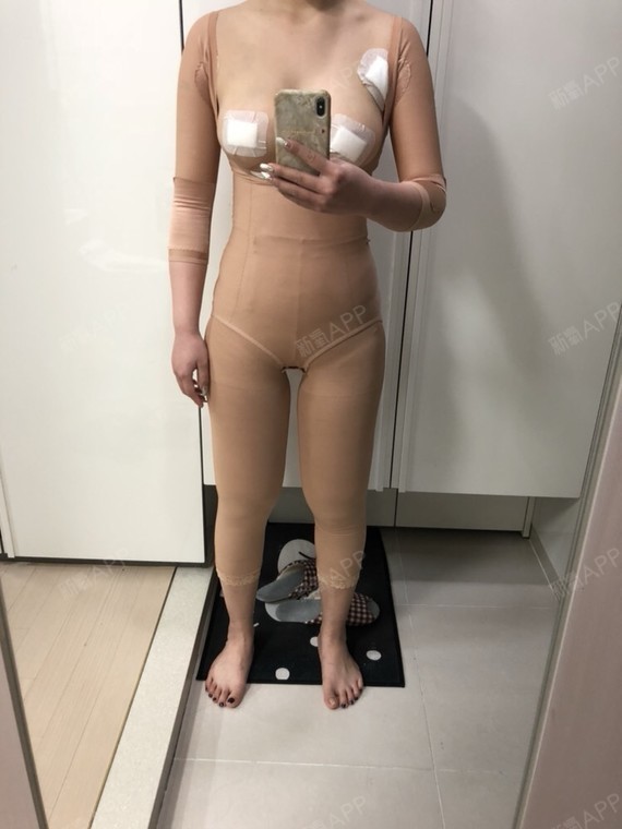 腹部吸脂