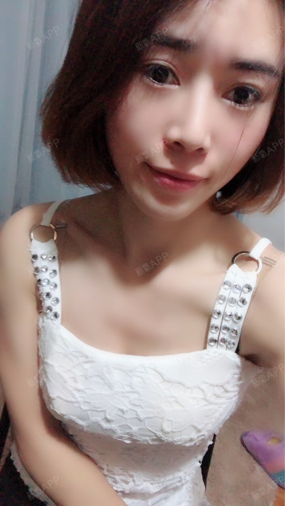 成都艾米丽自体脂肪隆胸第217天