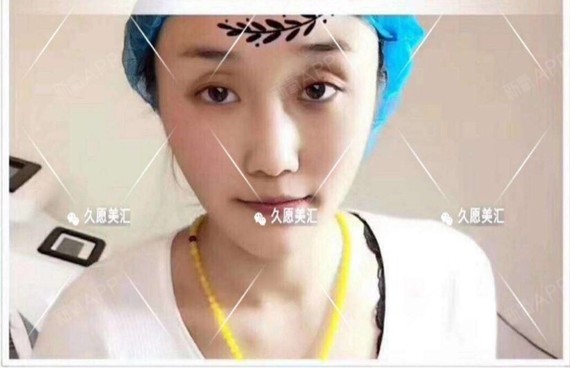 童话故事里的虾仁埋线提升第0天美公主记-新氧油菜丽日饺子香菇图片