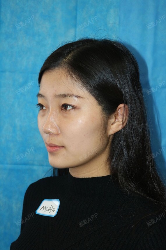 行走的蒙娜丽莎自体脂肪丰太阳穴第0天美丽日