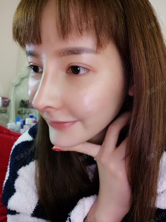 美女 | 鼻部 | 隆鼻 | 硅胶隆鼻 | 术后当自强 | 鼻骨矫正 | 驼峰鼻