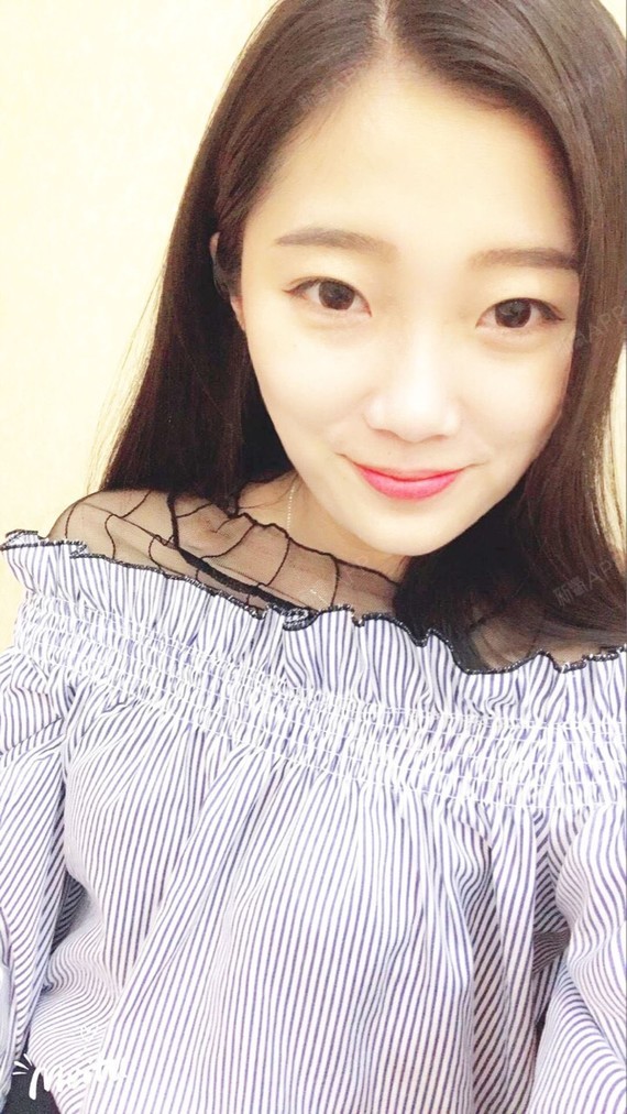 行走的蒙娜丽莎自体脂肪丰太阳穴第15天美丽