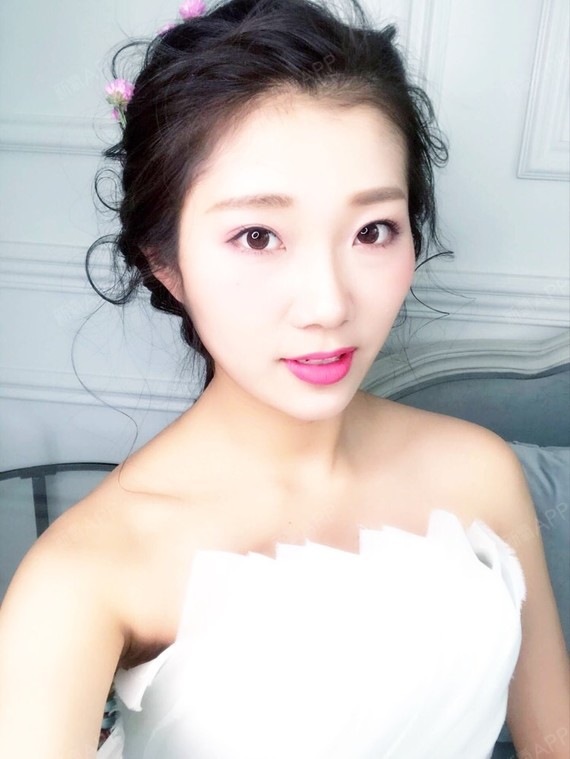 行走的蒙娜丽莎自体脂肪丰太阳穴第15天美丽