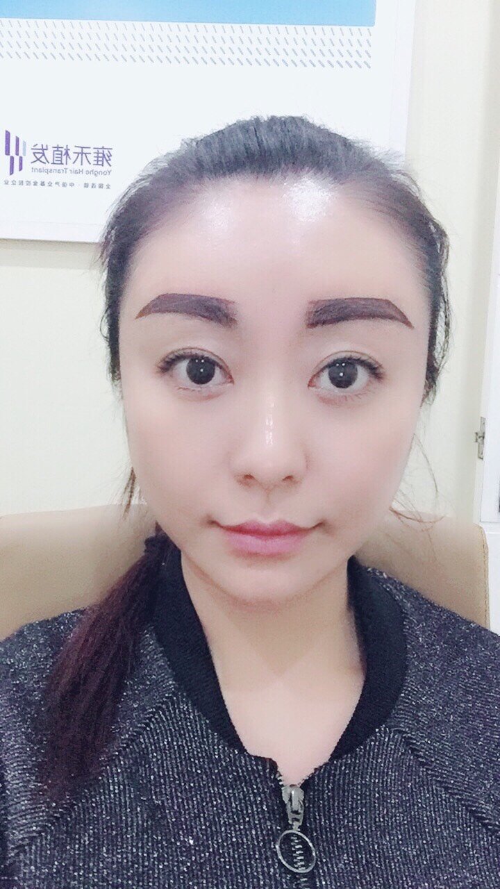 种植眉毛怎么样_恢复过程_效果如何_赵丽1整形日记2.