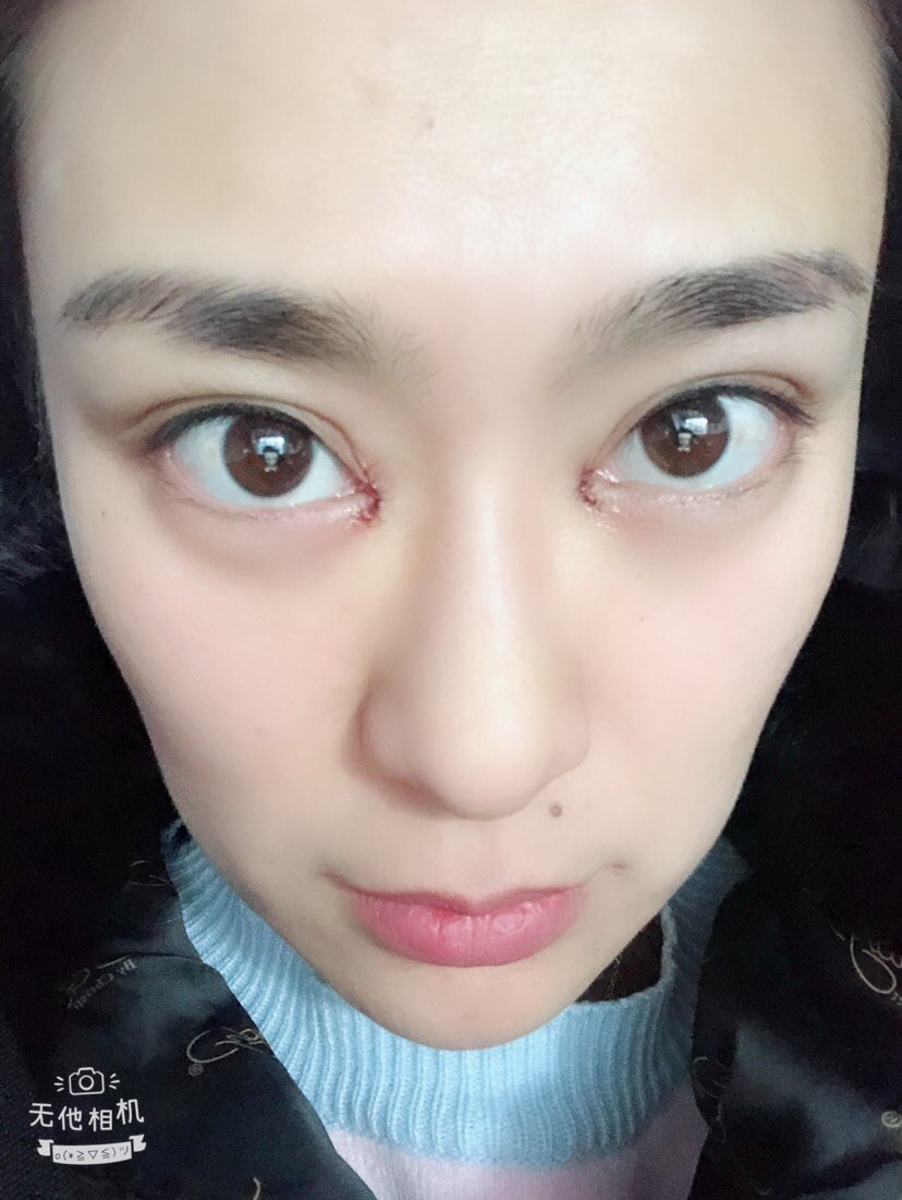 开内眼角怎么样_前后对比图_过程_氧气qwd2243整形2.