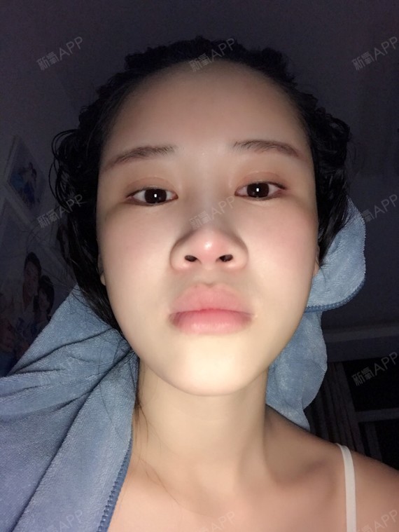 嗯,过几天两个月了,鼻尖歪鼻孔一大一小还是一样