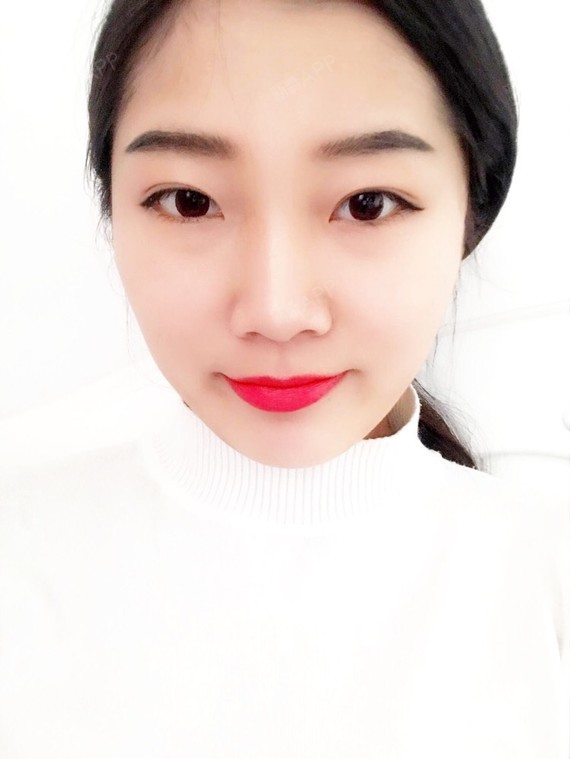 行走的蒙娜丽莎自体脂肪丰太阳穴第70天美丽