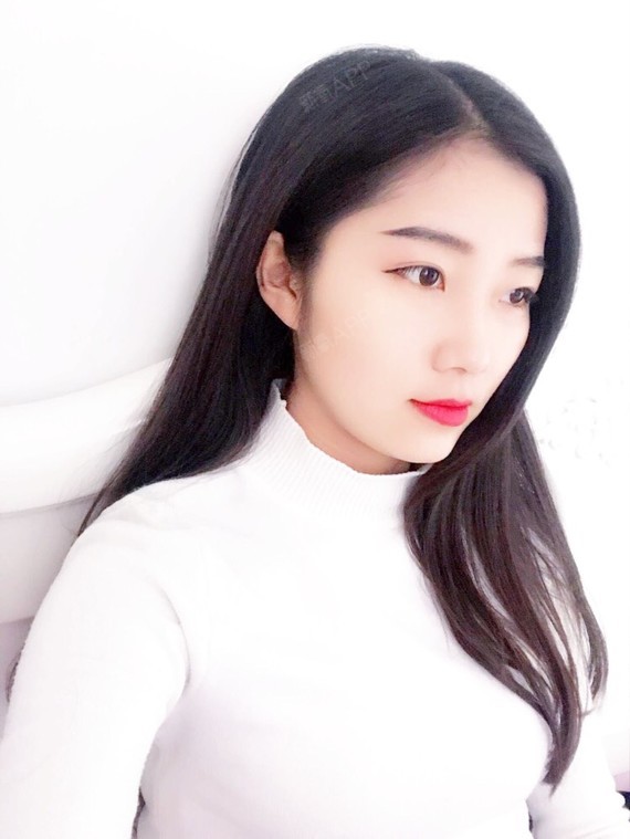 行走的蒙娜丽莎自体脂肪丰太阳穴第70天美丽