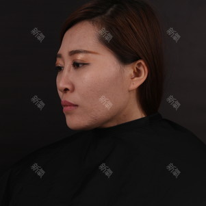 西安美莱医学美容医院肋软骨隆鼻怎么样?_路