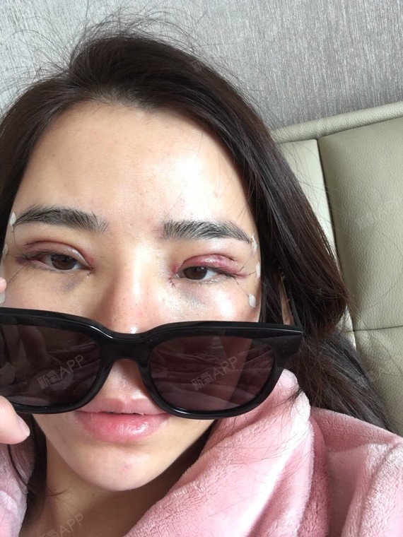 皮肤超好DM切开双眼皮第2天美丽日记-新氧美