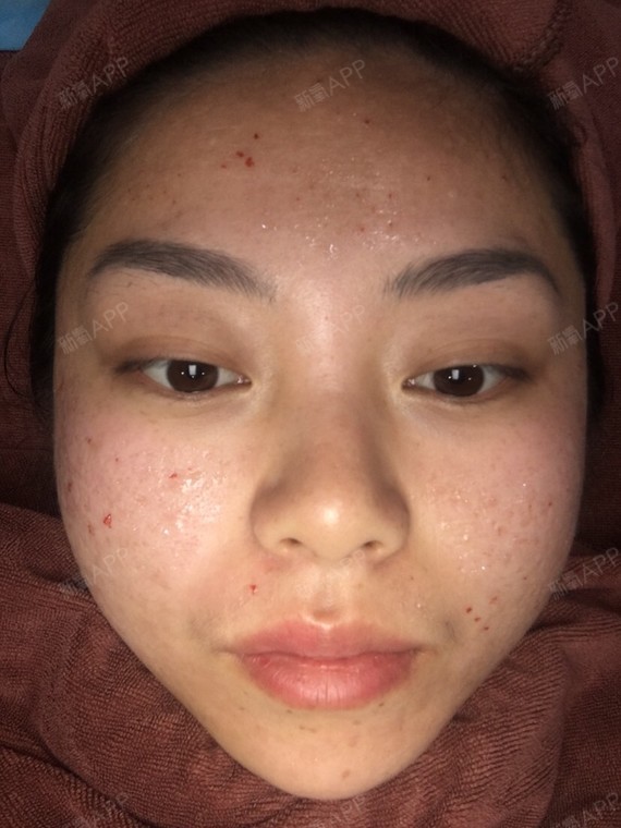 就打电话预约去了,到了先敷麻药在脸上,40分钟,对麻药过敏就不要做了