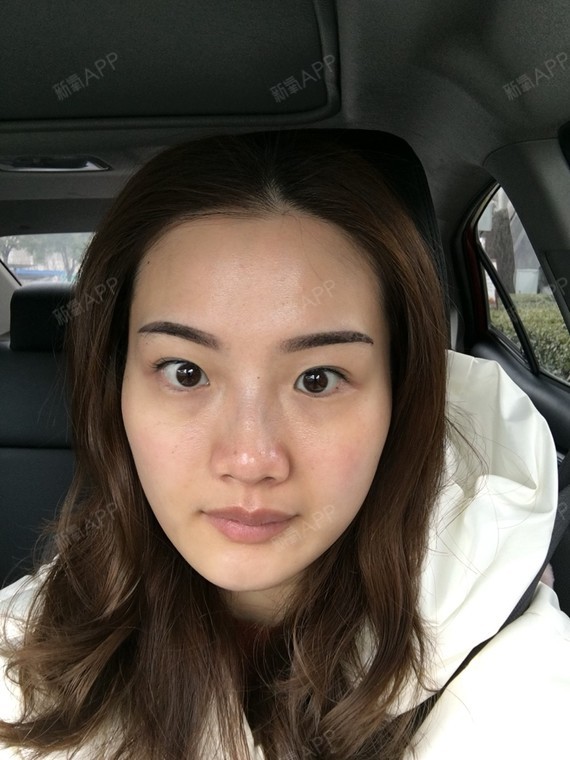 水光针第三天,针眼还是没闭合,但是颜色已经变淡了.