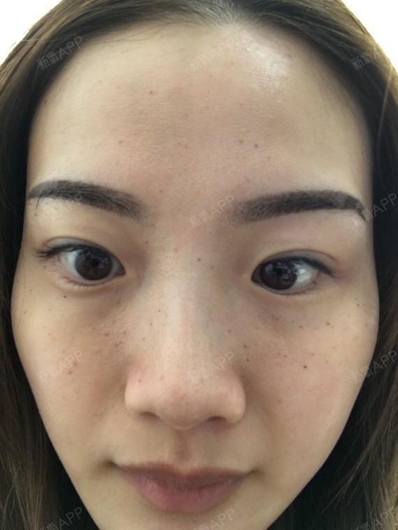 请问水光针打完之后可以用喷雾补水吗?针眼一般几天闭