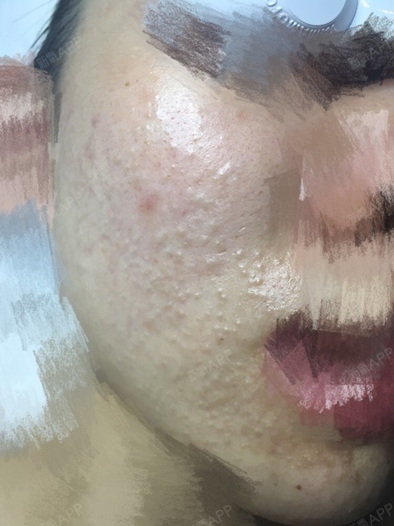 长了好多闭口粉刺,今天来赫尔斯针清,清出来好多东西_圈子-新氧美容