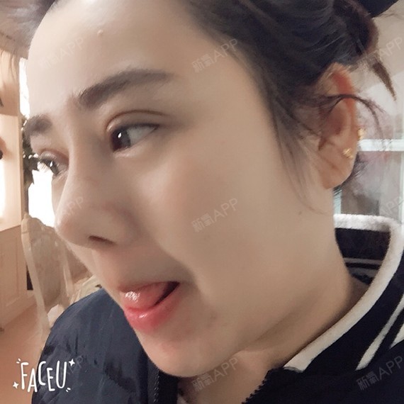 馥香鼻综合第0天美丽日记-新氧美容整形