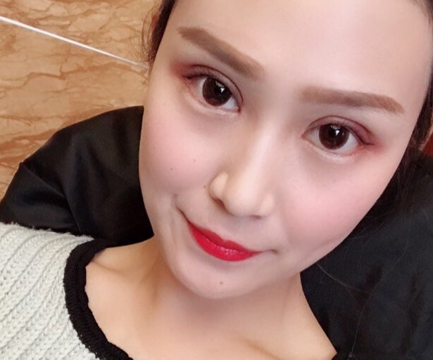 开内眼角怎么样_恢复过程_效果如何_你可爱的女孩整形