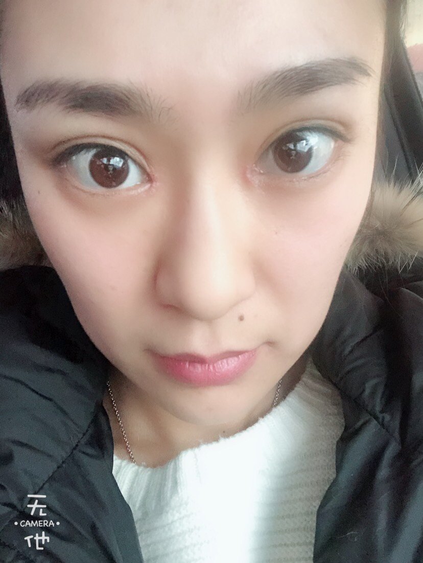 开内眼角怎么样_前后对比图_过程_氧气qwd2243整形2.