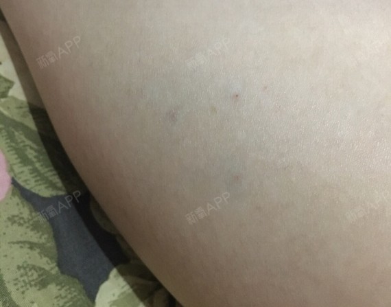 mmmmmmmmmnnn肉毒素瘦小腿第10天美丽日