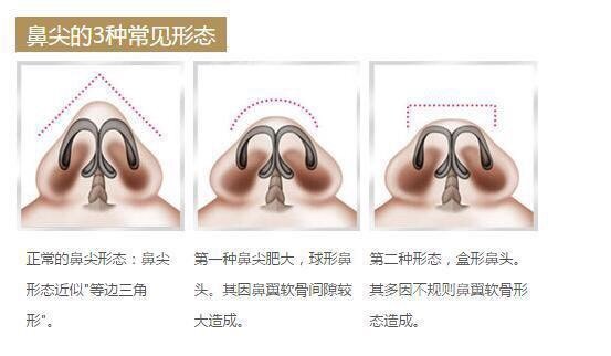 【广州美莱正版达拉斯隆鼻】鼻头如何缩小?要