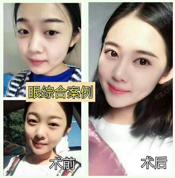 眼睛对于颜值的重要性毋庸置疑,一次成功的眼