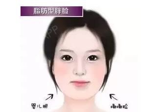 不是所有胖脸都适合打瘦脸针,咬肌肥大型大脸