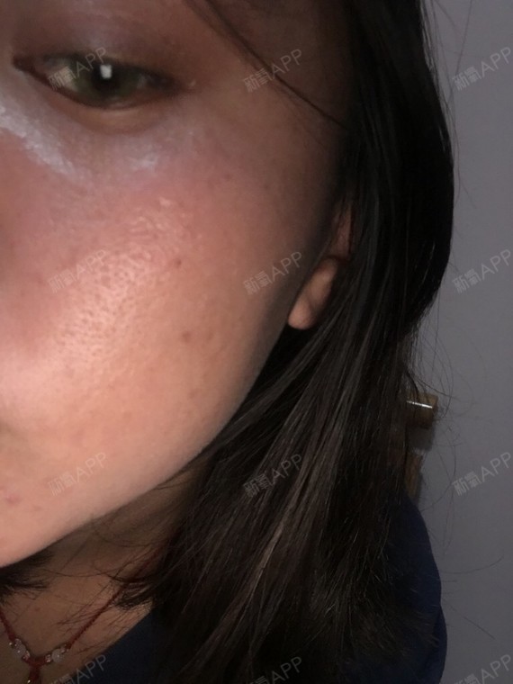 毛孔大,肤色暗沉粗糙,还有痘坑怎么办