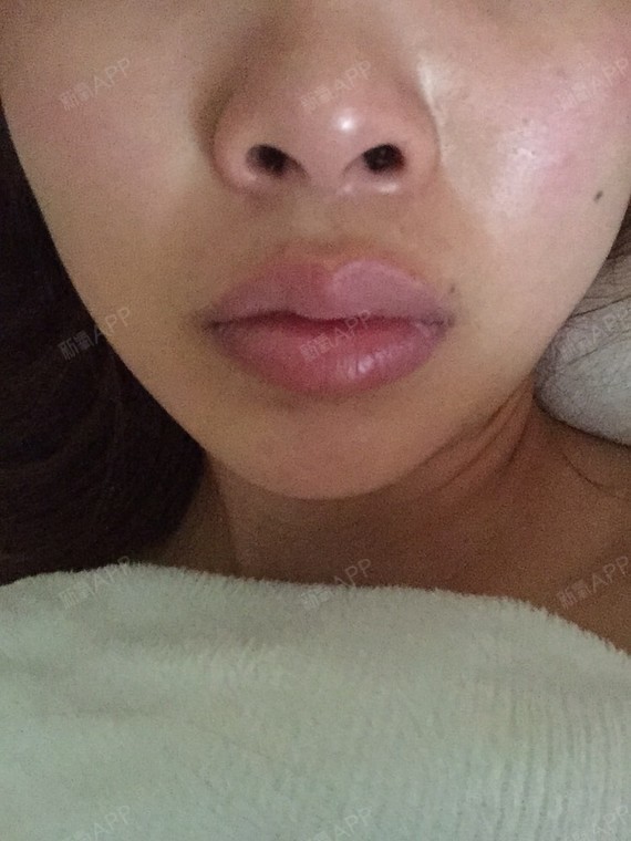 肿胀已经好很多了 两边还是不对趁 嘴唇里有硬结 一个一个疙瘩 感觉没