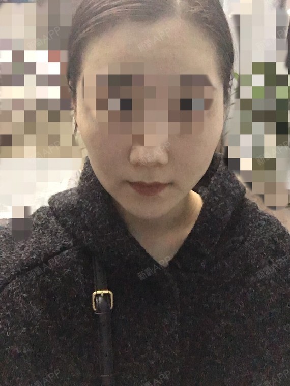 或是有埋线提升形成大小脸左右不对称的宝宝么?
