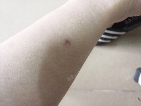 这个抽脂留下的伤口 不大 也没啥影响 所以宝宝们不用担心 面部抽脂