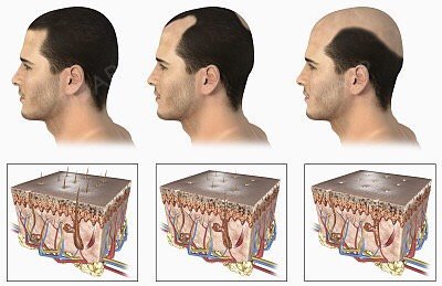 昨天小发遇到一个客户说他关注植发已经很长时