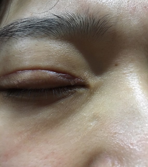 全切双眼皮45天,增生有点严重,涂积雪苷和芦荟胶可以吗?
