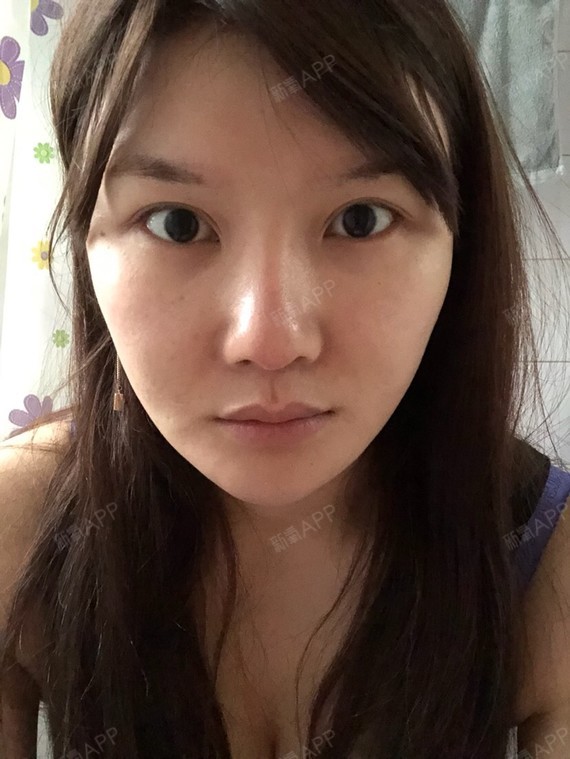 人气娃娃脸颧骨颧弓整形术第0天美丽日记-新氧