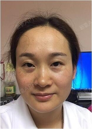 我的眼睛基础不太好,上眼睑的皮肤松弛,耷拉下